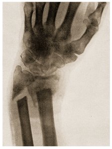 Raio X de um pulso fraturado c.1890 de German School