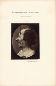 Eletrofisiologia fotográfica, Figura 39 de Guillaume Benjamin Duchenne