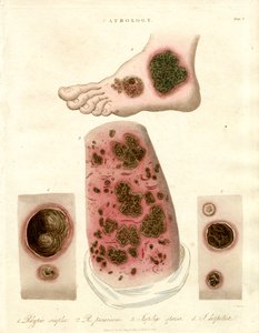 Doenças patológicas da pele - Pitiríase, Impetigo e Sífilis