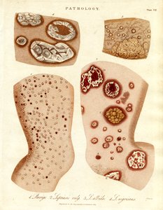 Condições patológicas da pele: Schurigie; Pele leprosa; Pallada e Impetigo de John Pass