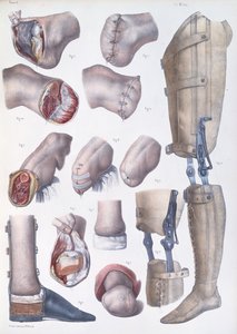 Amputações e próteses, placa do "Tratado Completo sobre a Anatomia do Homem", de Jean-Baptiste Marc Bourgery (1797-1849) 1866-67 de Nicolas Henri Jacob