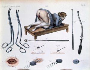 Uma operação numa fístula vesicovaginal, placa de 