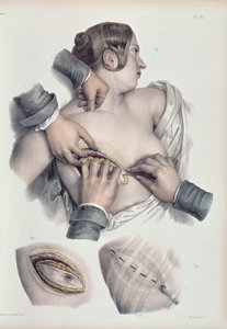 Operando em um tumor canceroso, de "Tratado Completo sobre a Anatomia do Homem", de Jean-Baptiste Marc Bourgery (1797-1849) 1866-67