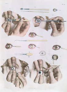 Operação em um olho, prato do "Tratado Completo sobre a Anatomia do Homem", de Jean-Baptiste Marc Bourgery (1797-1849) 1866-67 de Nicolas Henri Jacob