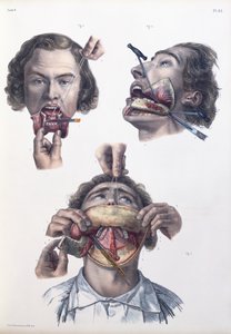 Operação no maxilar inferior, placa de "Traço Completo da Anatomia do Homem" por Jean-Baptiste Marc Bourgery (1797-1849) 1866-67