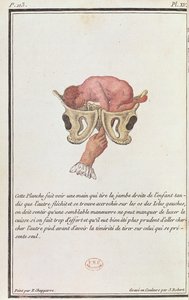 Diagrama transversal de um bebê retirado do útero pelo braço, de um livro de Madame Angelique Le Boursier du Coudray (1714-94), gravado por J. Robert, 1783 de P. Chapparre