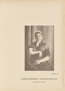 Atrofia cerebral: Epilepsia parcial Hemiplegia direita de Paul Marie Léon Regnard