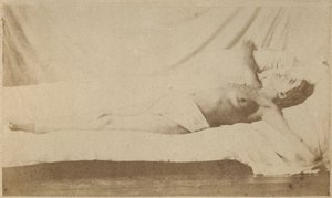 Epilepsia histérica, ataque, crucificação, placa VI de &39;Iconografia fotográfica de La Salpetriere&39; por Bourneville e P. Regnard, Paris, 1876 (impressão albumen)