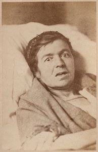 Epilepsia histérica, face de contração, placa VIII de &39;Iconografia fotográfica de La Salpetriere&39; por Bourneville e P. Regnard, Paris, 1876 (impressão albumen) de Paul Regnard