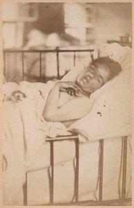 Epilepsia histérica, contração permanente, plana XXVIII de &39;Iconografia fotográfica de La Salpetriere&39; por Bourneville e P. Regnard, Paris, 1876 (impressão albumen)