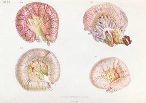 A superfície externa dos intestinos infectados com cólera, de Anatomie Pathologique du Cholera Morbus, por Nikolai Ivanovich Pirogov (1810-81), publicado em São Petersburgo, 1849 de Russian School