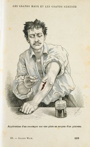 Pintando uma ferida com uma solução anti-séptica, c1890 de Unbekannt