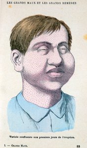 Vítima de varíola, c1890 de Unbekannt