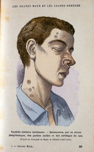 Sintomas da fase terciária da sífilis, século c19 de Unbekannt