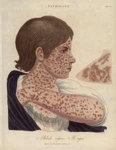 Sarampo e Rubeole - Litografia de John Pass, publicada na "Encyclopedia Londinensis" de John Wilkes, edição J.Adlard, Londres de Unbekannter Künstler