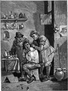 Um cirurgião charlatão no século 18, examinando uma lesão no ombro. (A partir de uma gravura do tempo). Gravura em "La Nature: Revue des sciences et de leurs applications aux arts et a l