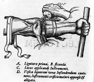 Tábua anatómica: diferentes ligaduras. Trabalho sobre o sistema sanguíneo por William Harvey (1578-1657), médico inglês. Ele descreveu a circulação do sangue no corpo através do intermediário das veias. de Unknown artist