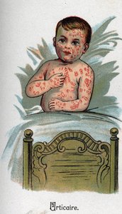 Doenças das crianças: Urticária. In" The new natural medicine" de F.E. Bilz. de Unknown artist