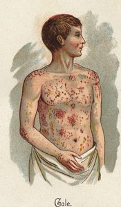 Doenças das crianças: A sarna. In" The new natural medication" de F.E. Bilz. de Unknown artist