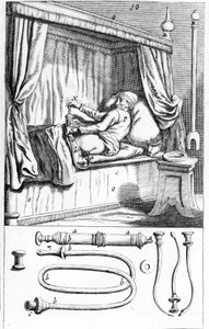 Clystère (para enemas) por Johannes Sculptetus "Armamentarium Surgical". Veneza 1665 de Unknown artist