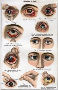 Doenças do Olho. "A nova medicina natural" por F.E. Bilz. de Unknown artist