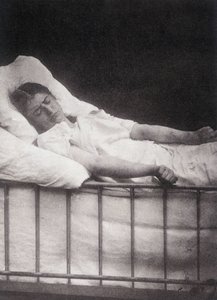 Hystero Epilepsie - Ataque tetanista na "Iconografia fotográfica da Salpétrière: serviço do Sr. Charcot" de Paul Regnard e Bourneville de Unknown artist