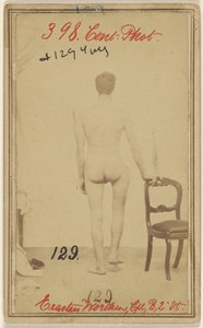 Fratura do terço superior do fémur. Erastus Worthen, Corpo Co. B. 2nd Vermont Vols. 25 anos - Residência Stockbridge VT. de Unknown artist