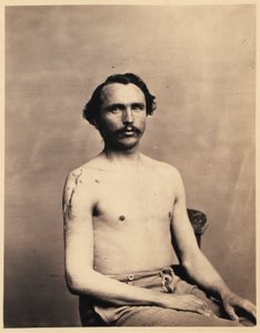 Soldado Adolph Zirsse, Excisão intermédia bem sucedida da cabeça e duas polegadas e meia do eixo do úmero direito, do Catálogo Fotográfico da Secção Cirúrgica