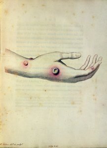 Pústula de varíola bovina no braço de Sarah Nelmes, de "Um Inquérito sobre as Causas e Efeitos das Variolae Vaccinae" de Edward Jenner (1749-1823) gravado por Pearce, c.1800