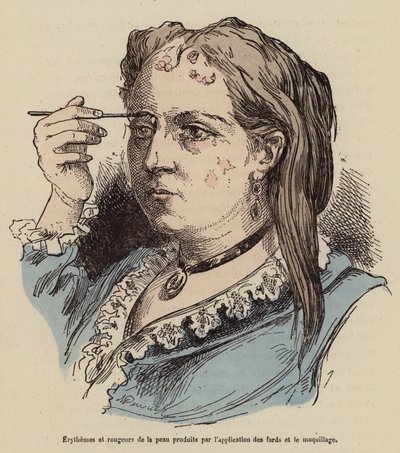 Mulher com erupções cutâneas e vermelhidão causadas pela utilização de maquilhagem (gravura a cores) de (after) French School