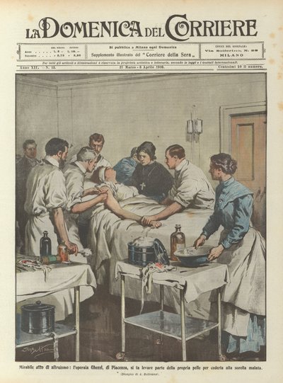 O ato Mirabile de altruísmo, o trabalhador Ghezzi, de Piacenza, eleva parte de sua pele de Achille Beltrame