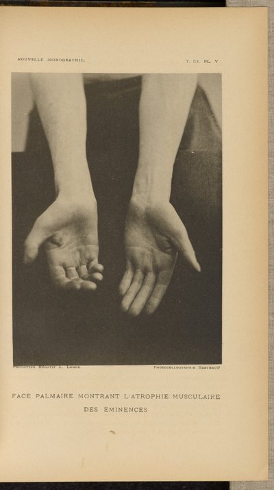 Superfície palmar com atrofia muscular das eminências de Albert Londe