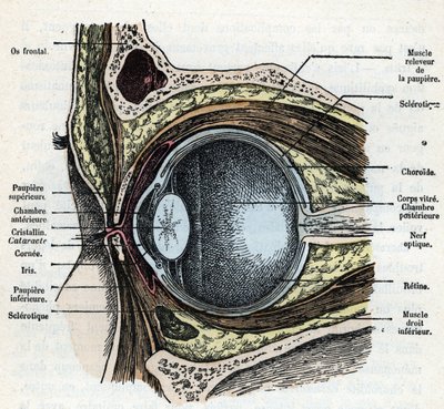 Corte vertical de um globo ocular com gravação de cataratas da colecção privada "Nature and Man" de Rengade 1881 de Alphonse Demarle
