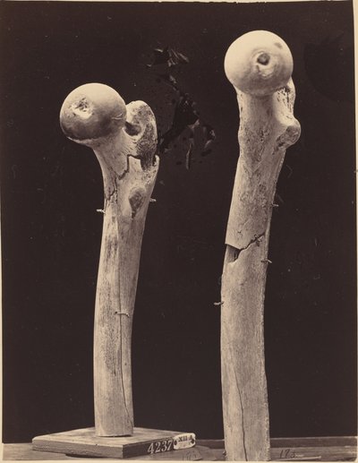 Espécimes de fraturas por arma de fogo do fêmur de American 19th Century