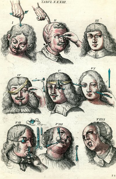 Cirurgia no século XVIII: Trepanação e operação do olho e da cara. Gravura em "Institutionis chirurgicae" de Lorenzo Heister de Anonymous Anonymous