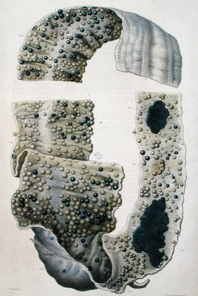 Doenças dos intestinos, de "Anatomie Pathologique du Corps Humain" de Jean Cruveilhier (1791-1874) 1828-42 (gravura colorida) de Antoine Chazal