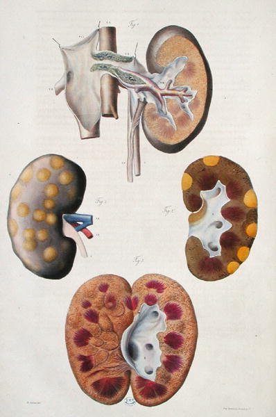 Doenças dos rins, de "Anatomie Pathologique du Corps Humain" de Jean Cruveilhier (1791-1874) 1828-42 (gravura colorida) de Antoine Chazal