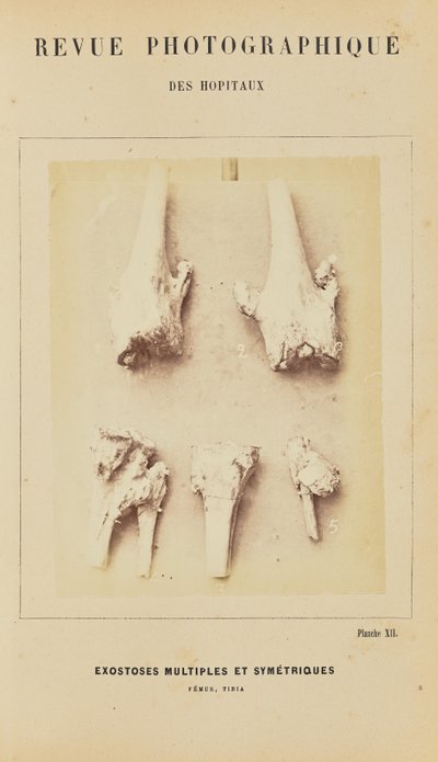 Exostoses simétricas múltiplas, fémur, tíbia de Arthur de Montmeja