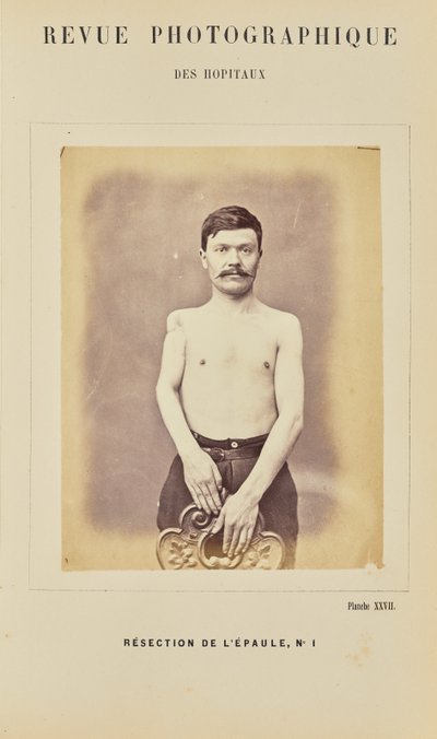Ressecção do ombro, número 1 de Arthur de Montmeja