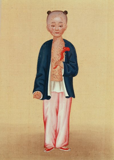 Criança com varíola (wc no papel) de Chinese School