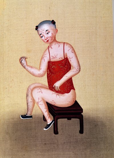 Criança com varíola (wc no papel) de Chinese School