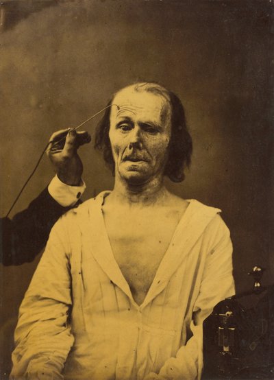 Um rosto relaxado à esquerda, Atenção profunda à direita, 1854-1856, impresso em 1862. de Duchenne de Boulogne
