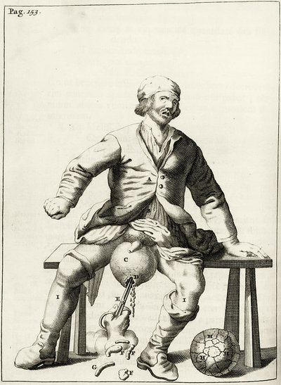 Drenagem do fluido do Hidrocelo do escroto, a partir dos exercícios práticos para curar método por Frederic Dekkers, 1694 de Dutch School