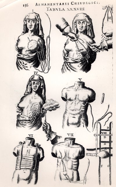 Operando no câncer de mama, de Armamentarii Chirurgici, de Johannes Schultes (1595-1645), publicado em Amsterdã, 1672 de Dutch School