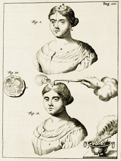 Tratar um doente de epilepsia, a partir dos exercícios práticos para curar método pelo Frederic Dekkers, 1694 de Dutch School