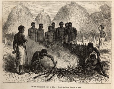 Método cirúrgico usado para curar fraturas, o ferido é sentado em um buraco, a perna é banida por uma folha, depois o poço é preenchido com lama e coberto com gemas que estão inflamadas e aquecem a fratura, o paciente é protegido por um tapete que serve co de Edouard Riou