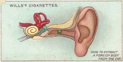 Corpo estranho em ouvido, não. 30 da série de primeiros socorros de cartões de cigarros Willss, 1913 de English School