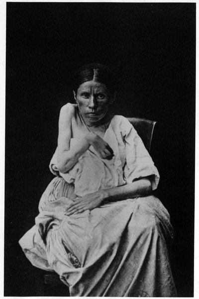 Fotografia de um paciente que sofre de epilepsia hemiplégica, -in "fotografia iconográfica do Salpetrière, Bourneville e P. Regnard, Paris de French Photographer