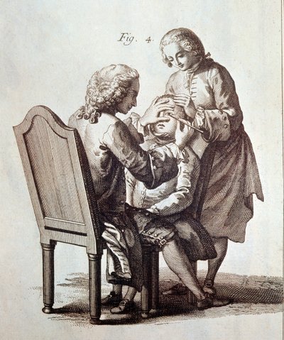 Um médico a operar um doente com cataratas, ilustração da Enciclopédia Médica de Denis Diderot e Jean le Rond d