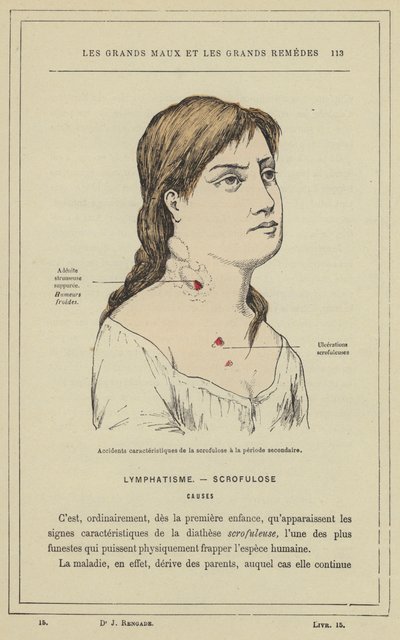 Acidentes característicos de escrofulose no período secundário (cor litho) de French School
